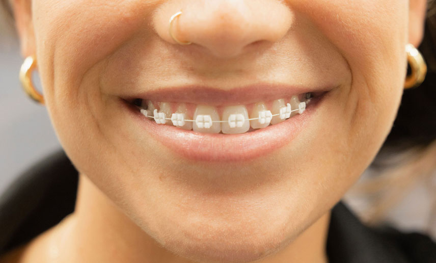 Everything You Need to Know About LightForce™ Braces